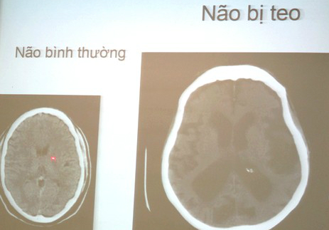 Ảnh chụp teo não (qua SK&DS)